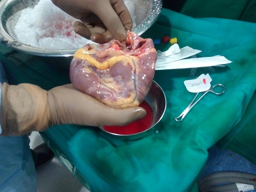First Ever Heart Transplant in Marathwada